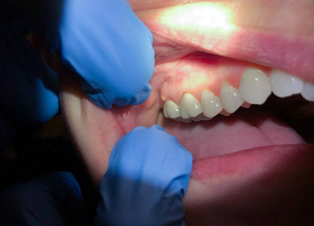 Best Emergency Broken Tooth Repair in Wye, MT