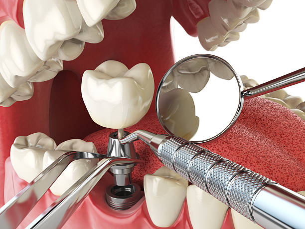 Best Emergency Broken Tooth Repair in Wye, MT